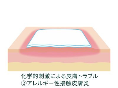 化学的刺激による皮膚トラブル(アレルギー性接触皮膚炎)のイメージ画像です
