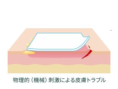 物理的(機械的)刺激による皮膚トラブルのイメージ画像です