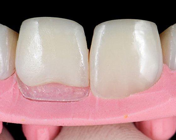 Placing a palatal composite shell