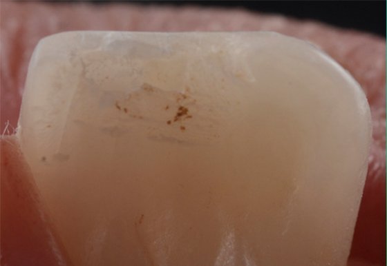 Palatal pre-operative
