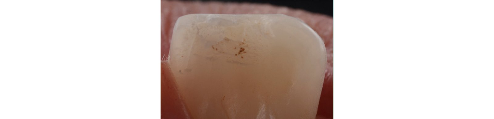 Palatal pre-operative