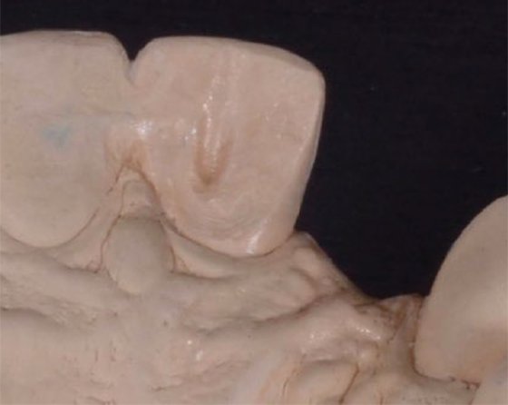 Palatal view of preparation on model