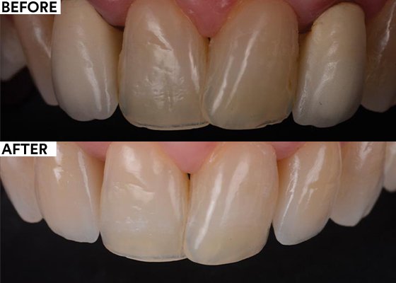 Informative oral care related imagery with a file name of MedzinBond2Veneer-560.jpg shown on Solventum's "Brain Floss" blog