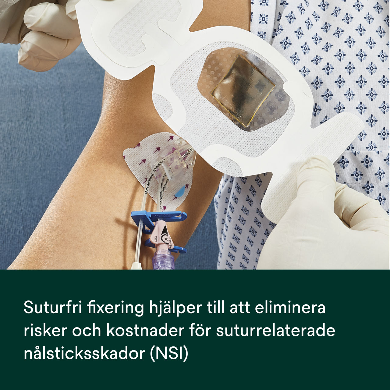 (3) PICC/CVC-anordning + CHG IV-förband: Suturlös säkring