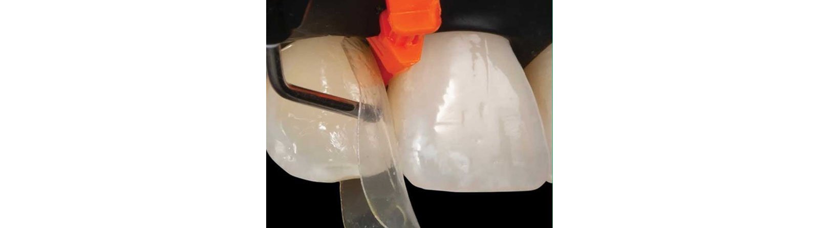 Placed adhesive and injected composite