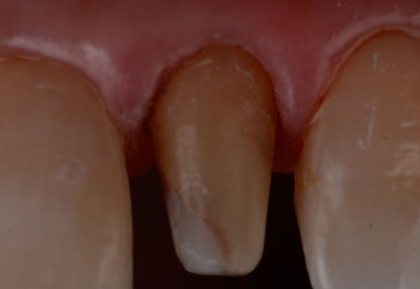 Tooth abutment after complete removal of the paste