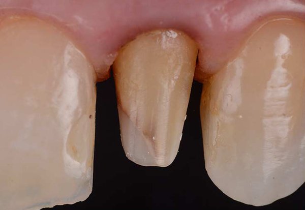 Existing crowns were removed