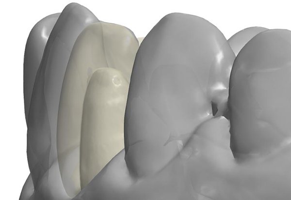 Computer-aided design of the monolithic crowns