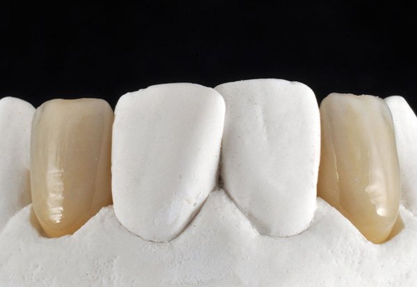 Master cast with two beautifully shaped and colored crowns