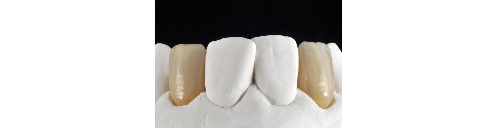 First application of 3M™ Filtek™ Universal Restorative, Shade A1, was placed
