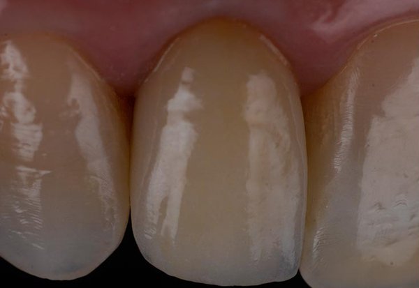 Try-in of the crown on the right lateral incisor