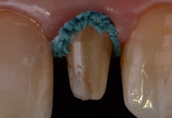 Preparations for cementation