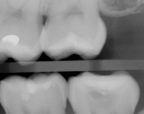 Pre- and post-operative radiographs of the completed endo-restorative procedure