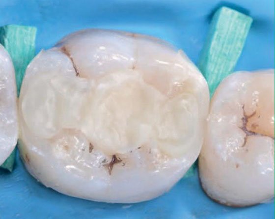 Prepared tooth is filled with composite