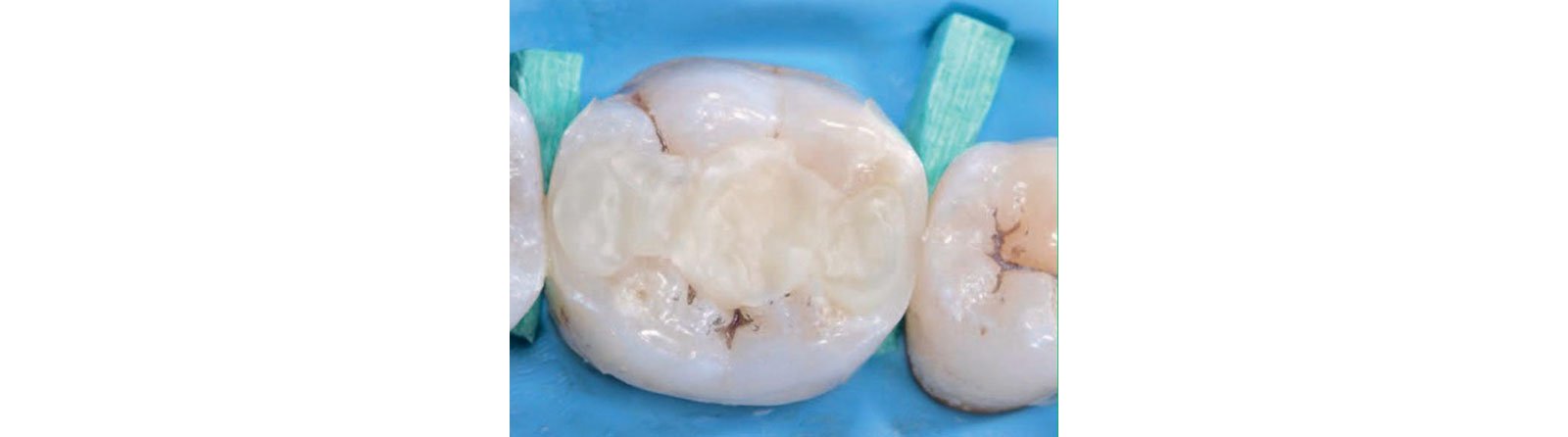 Prepared tooth is filled with composite