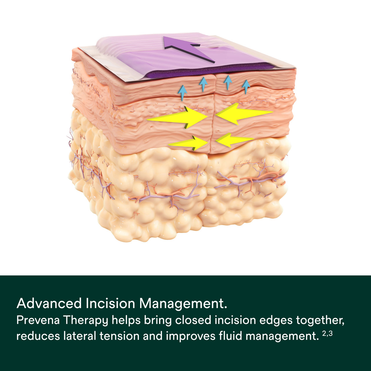 Prevena Restor Adapti-Form System Kit - PDP Image 4