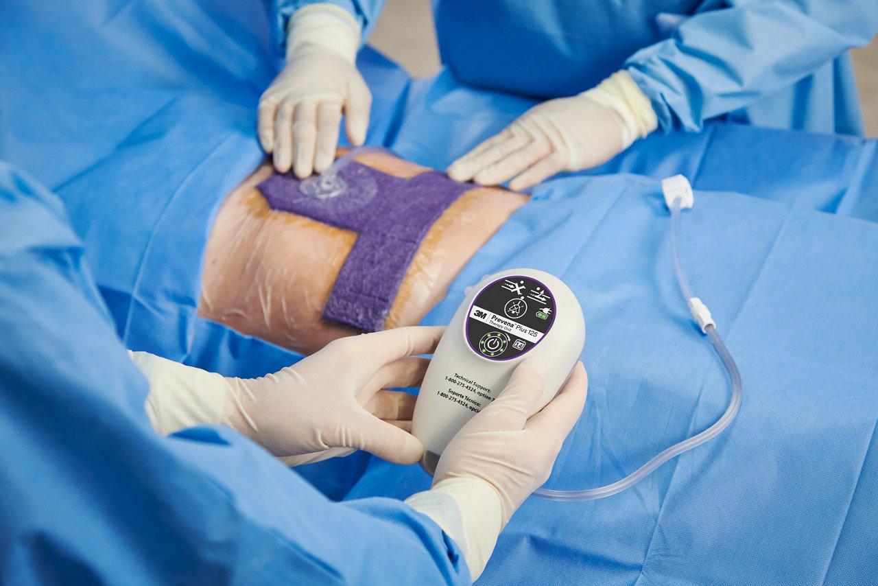 Medical personnel with 3M™ Prevena™ Plus 125 Therapy Unit attached to an abdominal surgical incision. Application image, person image, product application image, high resolution, 300dpi, RGB, tiff