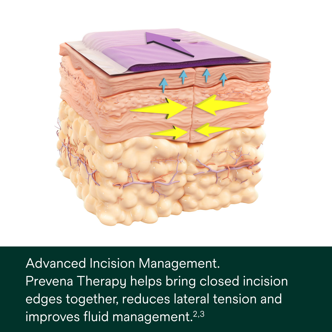 Prevena Restor Artho Form Dressing - PDP Image 4