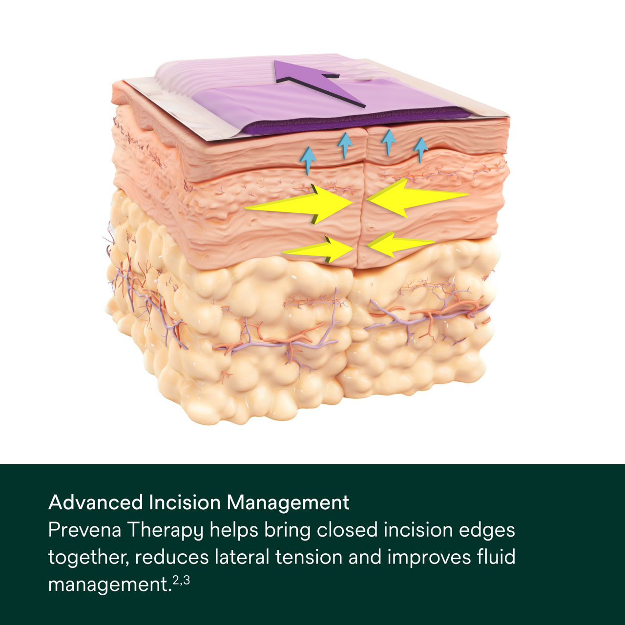 Prevena Restor Artho Form System - PDP Image 4