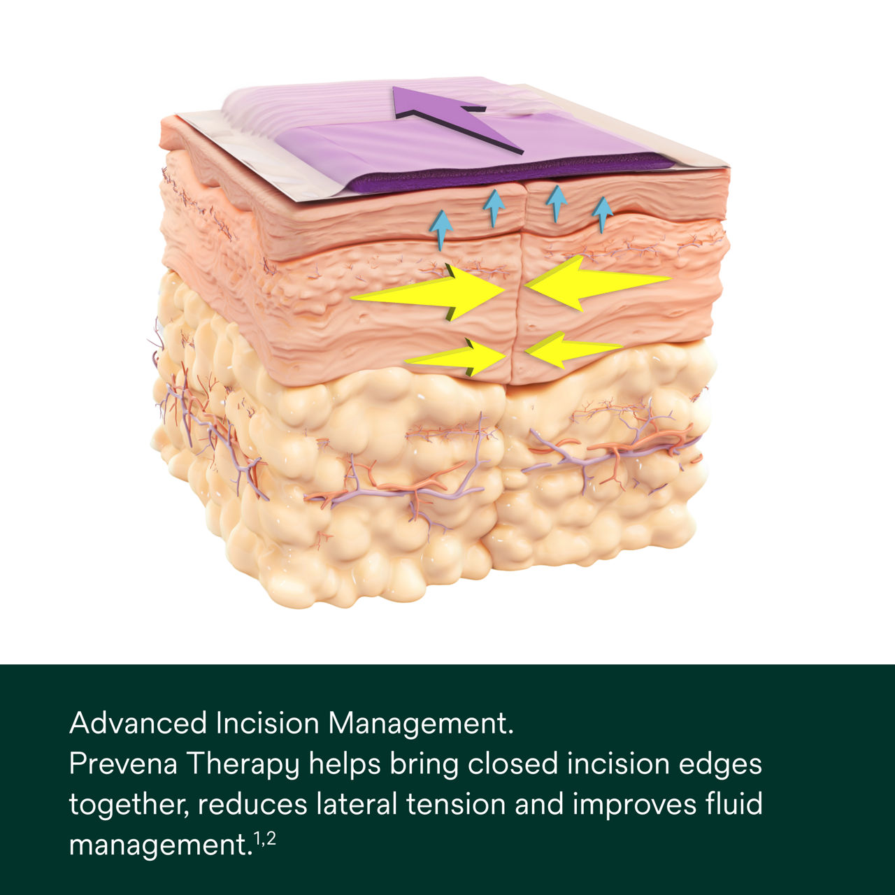 Prevena Restor Axio Form Dressing - PDP Image 4