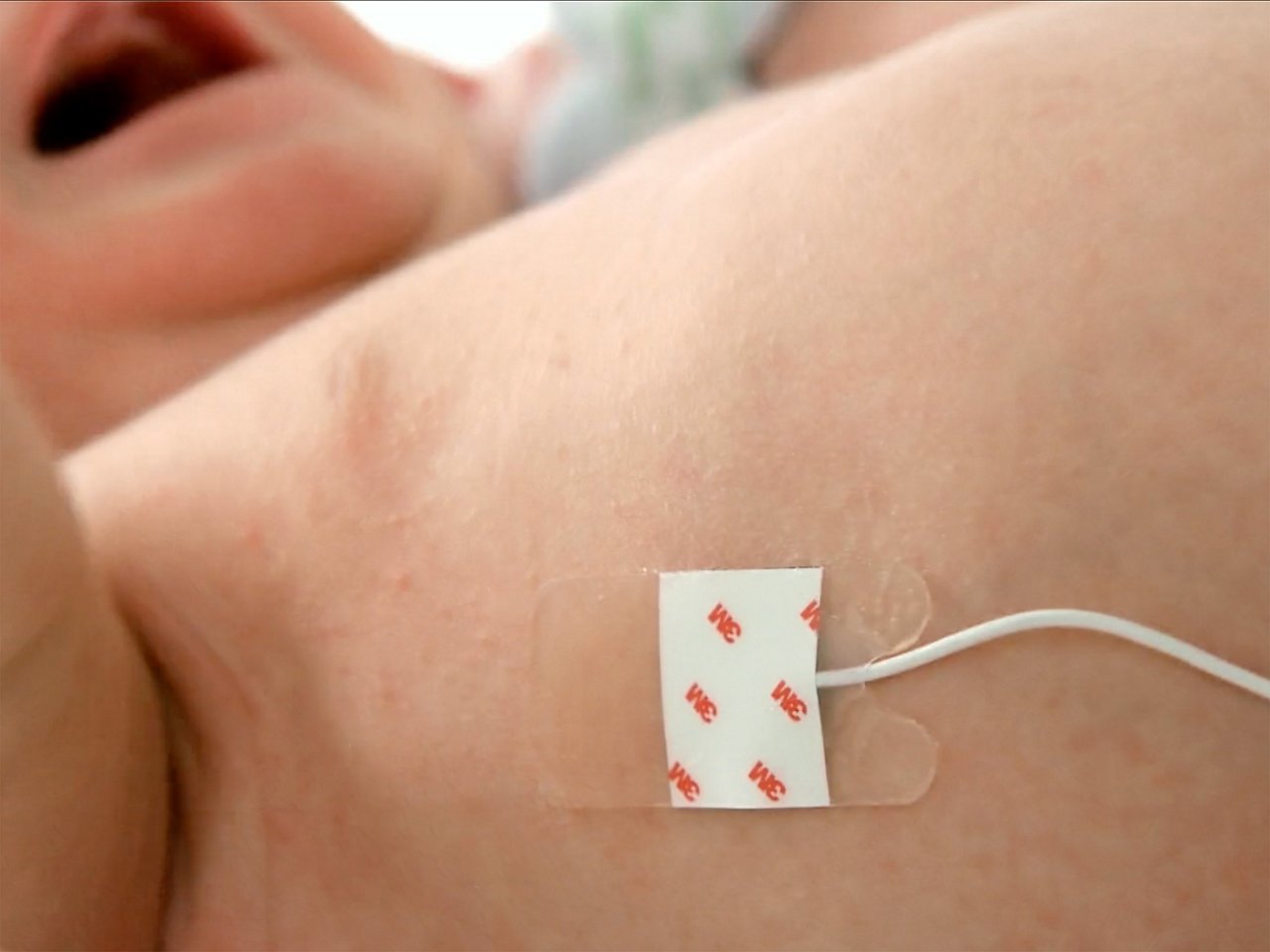 A baby having red dot electrodes applied to upper torso