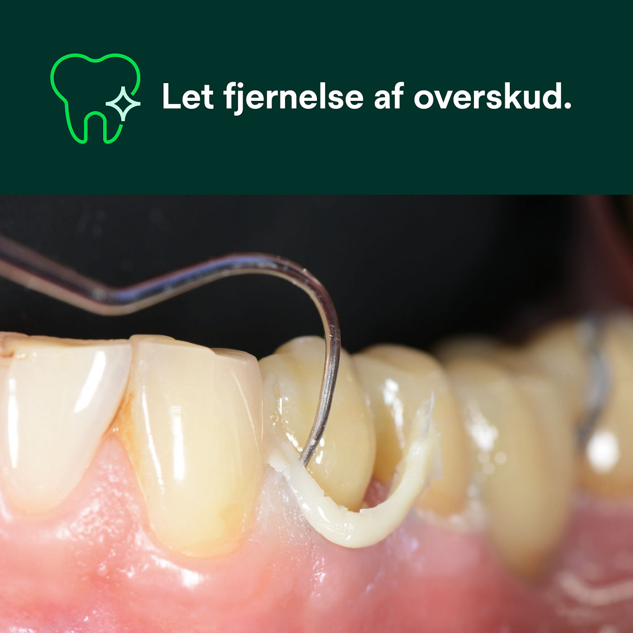 (1) RelyX™ Universal Resincement: Let fjernelse af overskud.