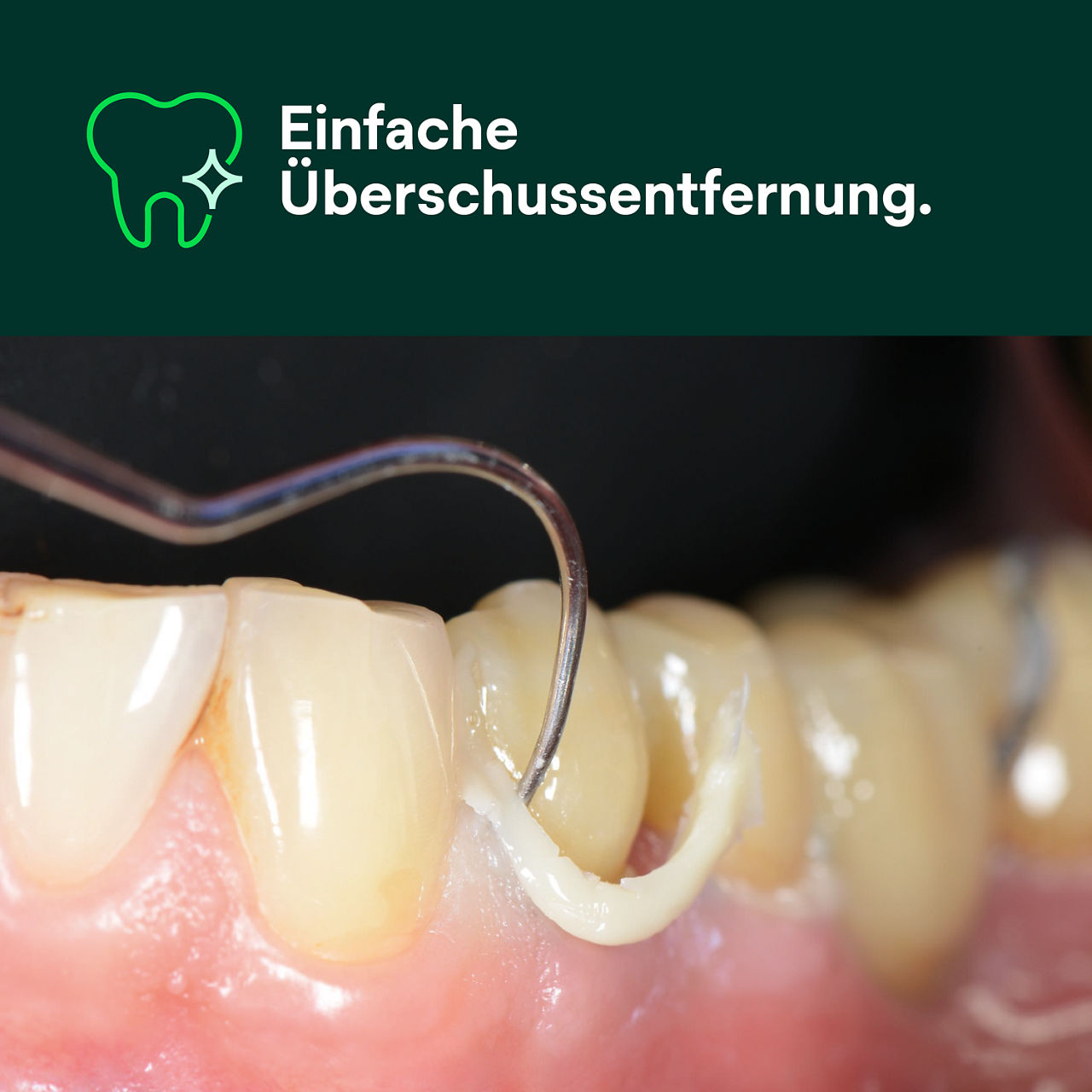 (1) RelyX™ Universal Resin Cement: Einfache Überschussentfernung.