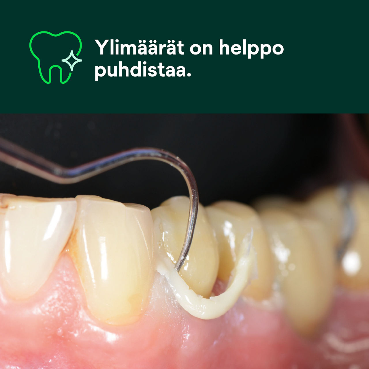 (1) RelyX™ Universal -muovisementti: Ylimäärät on helppo puhdistaa.