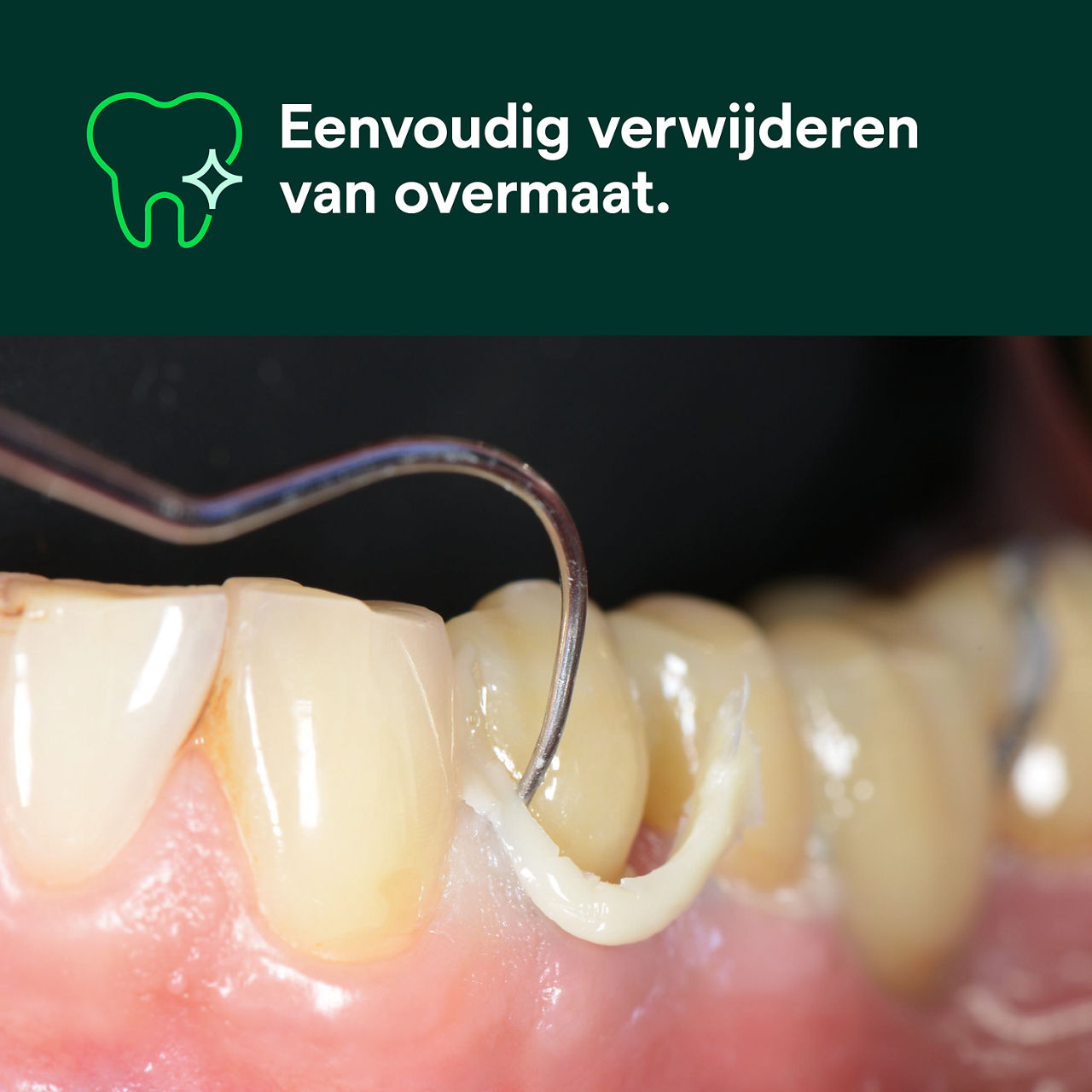 (1) RelyX™ Universal Composietcement : Eenvoudig verwijderen van overmaat.