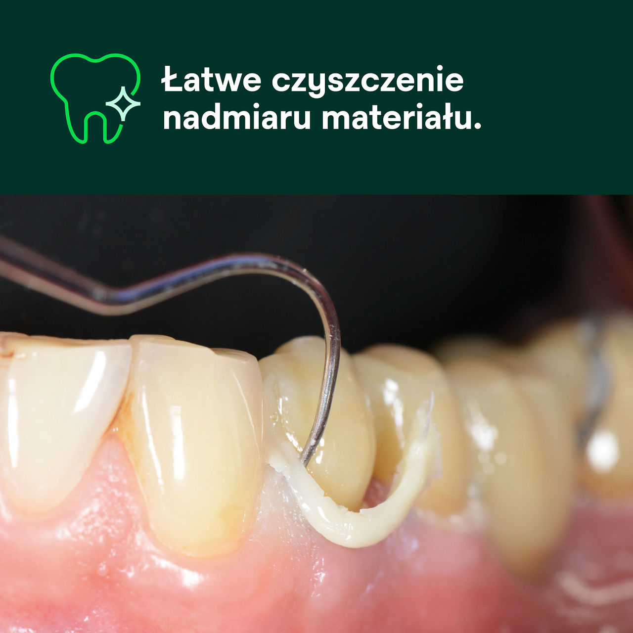 (1) RelyX™ Universal uniwersalny cement: Łatwe czyszczenie nadmiaru materiału.