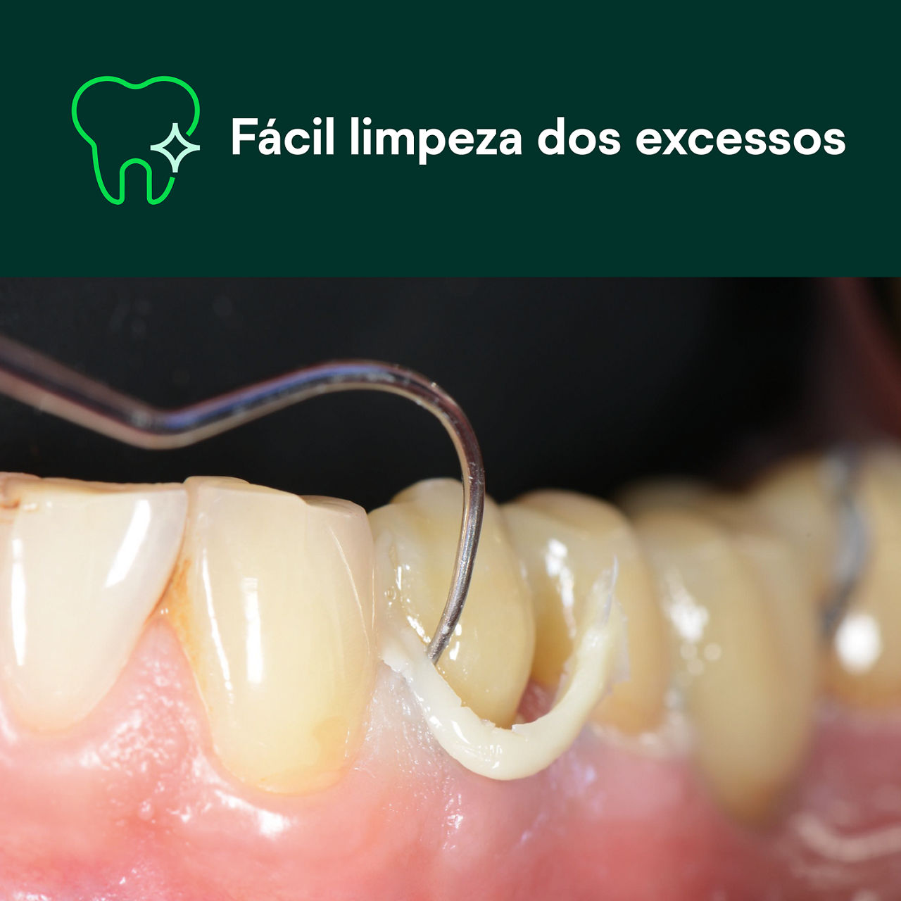 (1) Cimento de resina RelyX™ Universal cemento: Fácil remoção do excesso.