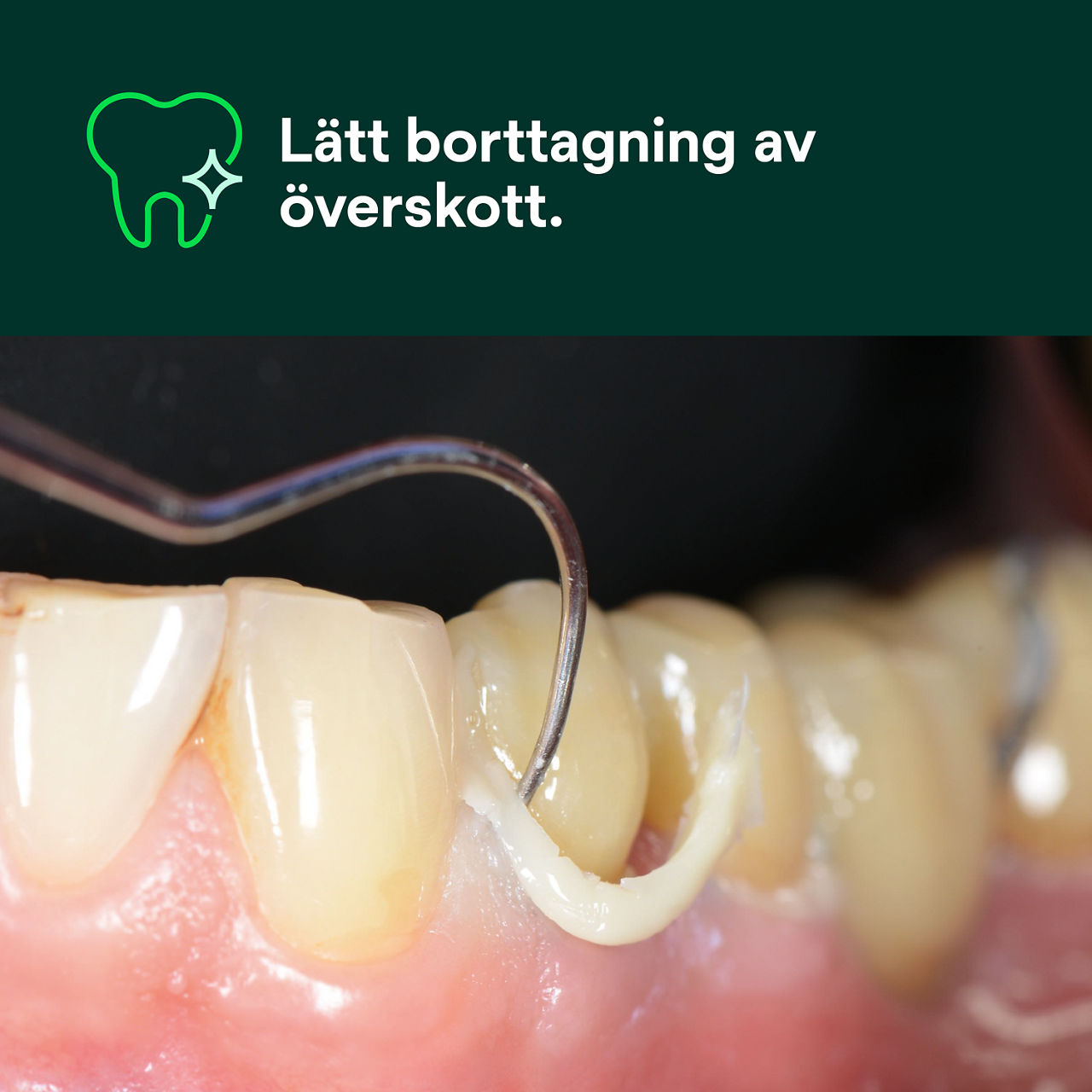 (1) RelyX™ Universal Resin Cement: Lätt borttagning av överskott.