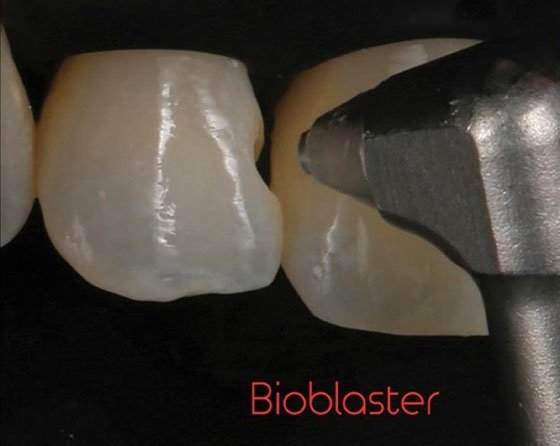 Removed Biofilm using Bioclear Blaster