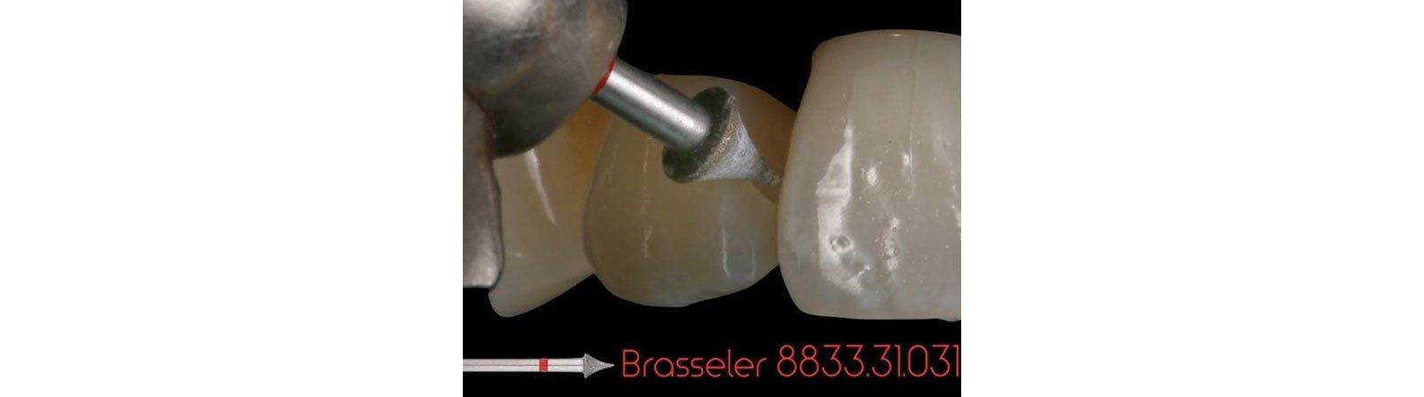 Removed decay, finessed prep, and created radius bevel