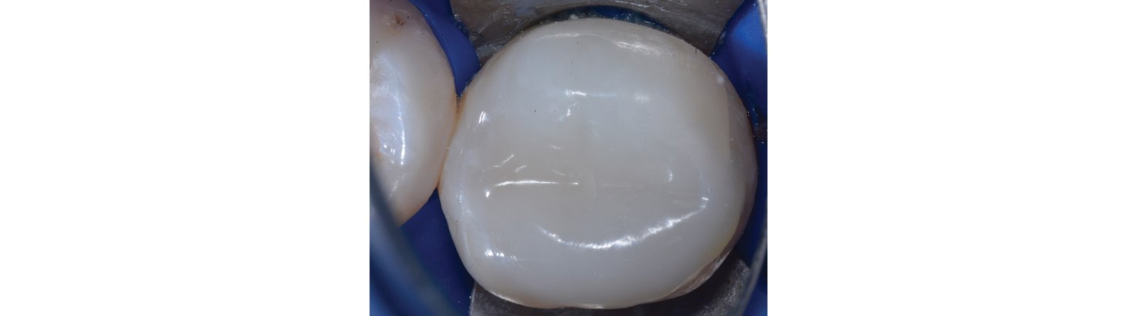 3M™ Filtek™ One Bulk Fill Restorative Composite, Shade B1, is used for a balance of esthetics and performance, plus 4mm depth of curve
