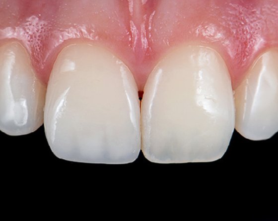 Beautiful restored upper-left central incisor (immediate post-op)