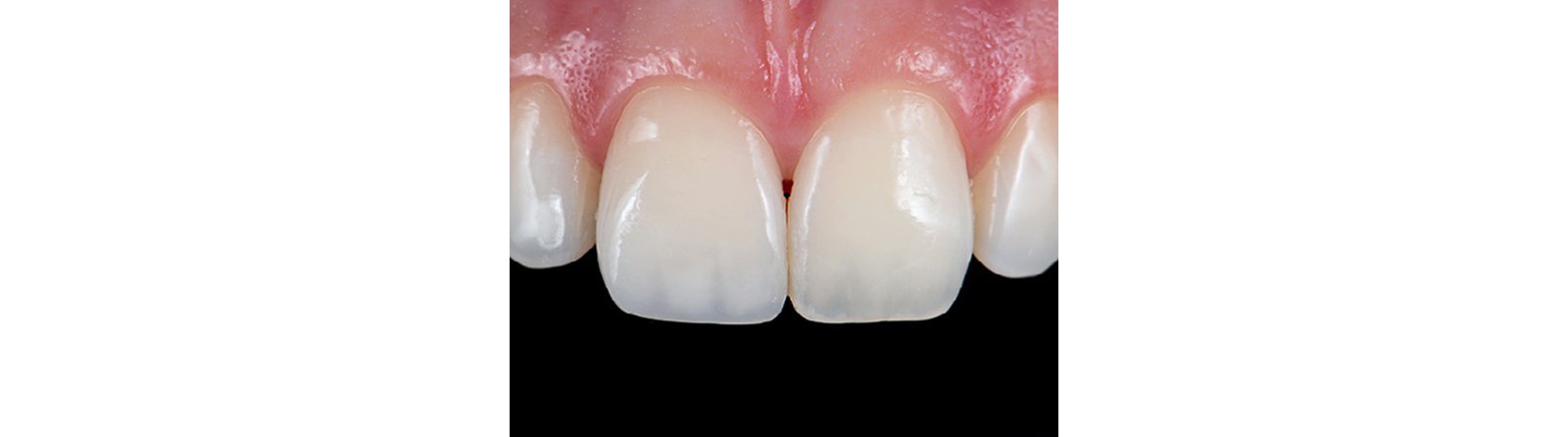 Beautiful restored upper-left central incisor (immediate post-op)