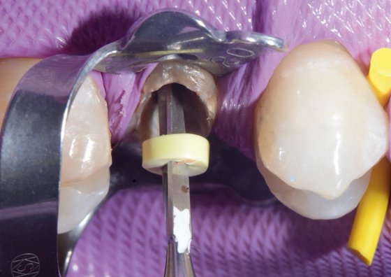 Preparation of the root canal