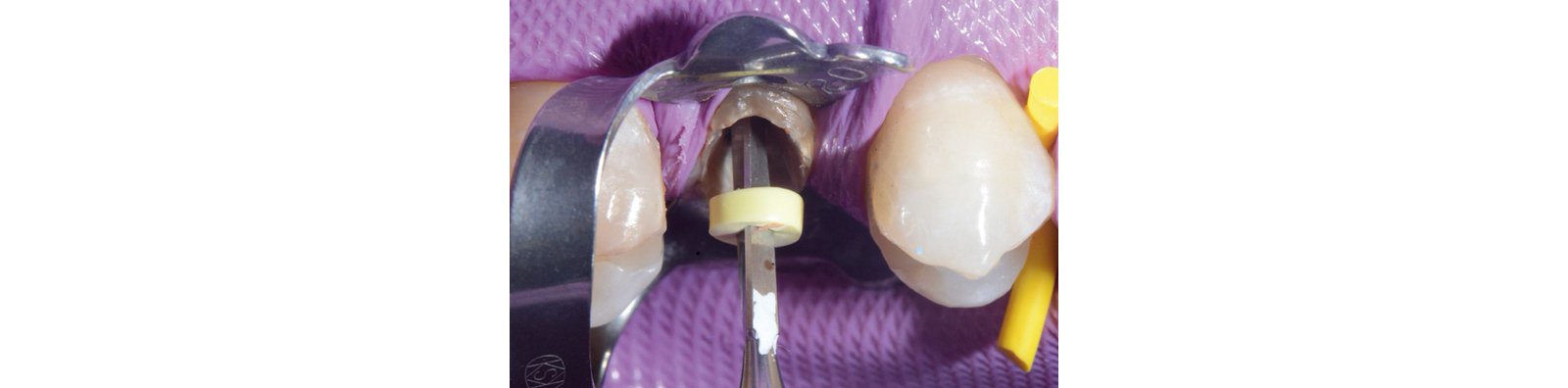 Preparation of the root canal