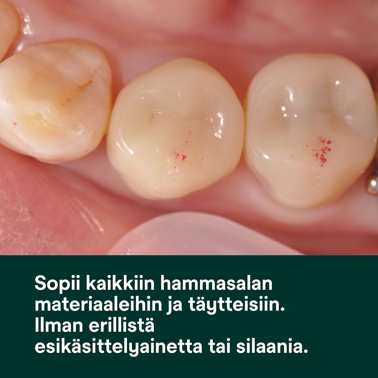 (1) Scotchbond Universal Adhesive: Sopii kaikille hammaspinnoille ilman ylimääräistä esikäsittelyainetta