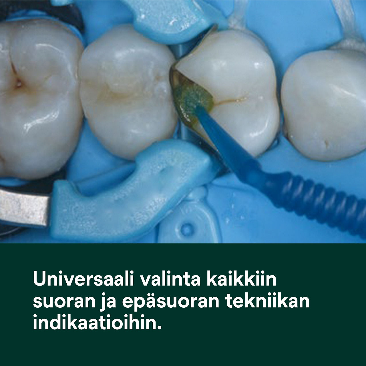 (1) Scotchbond Universal Plus Adhesive: Universaalisti sopiva kaikkiin suoriin ja epäsuoriin käyttötarkoituksiin