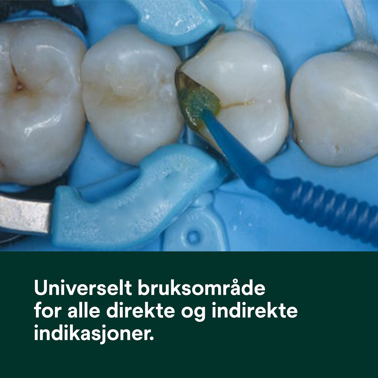 (1) ScotchBond™ Universal Adhesive Plus: Universelt egnet for alle direkte og indirekte indikasjoner