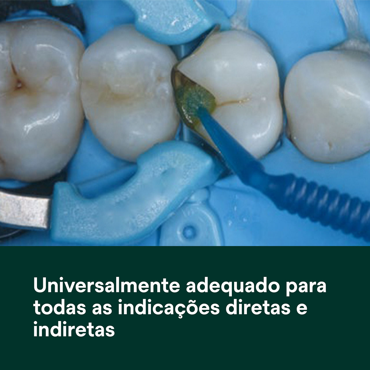 (1) Scotchbond Adesivo Universal Plus: Universalmente adequado para todas as indicações diretas e indiretas