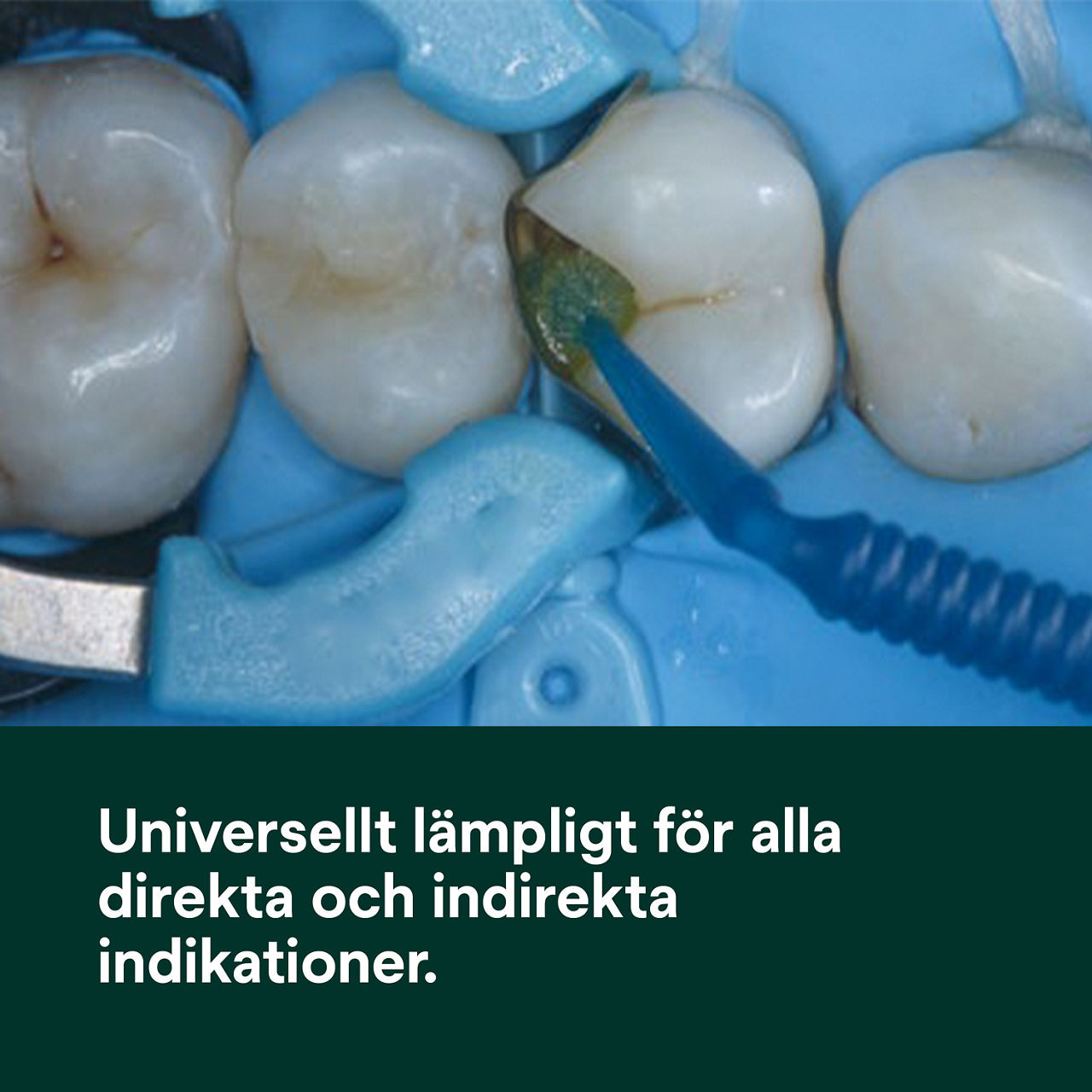 (1) Scotchbond™ Universal Adhesive Plus: lämplig för alla direkta och indirekta indikationer