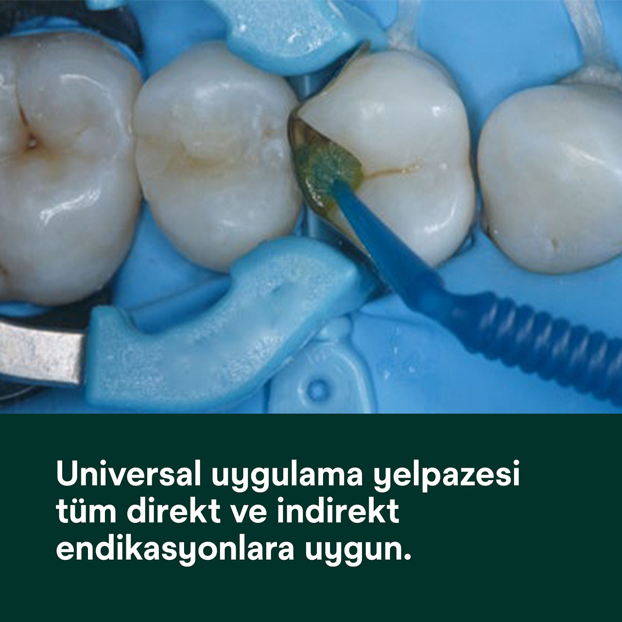 (1) Scotchbond Universal Plus Yapıştırıcı: Tüm doğrudan ve dolaylı endikasyonlar için evrensel olarak uygun