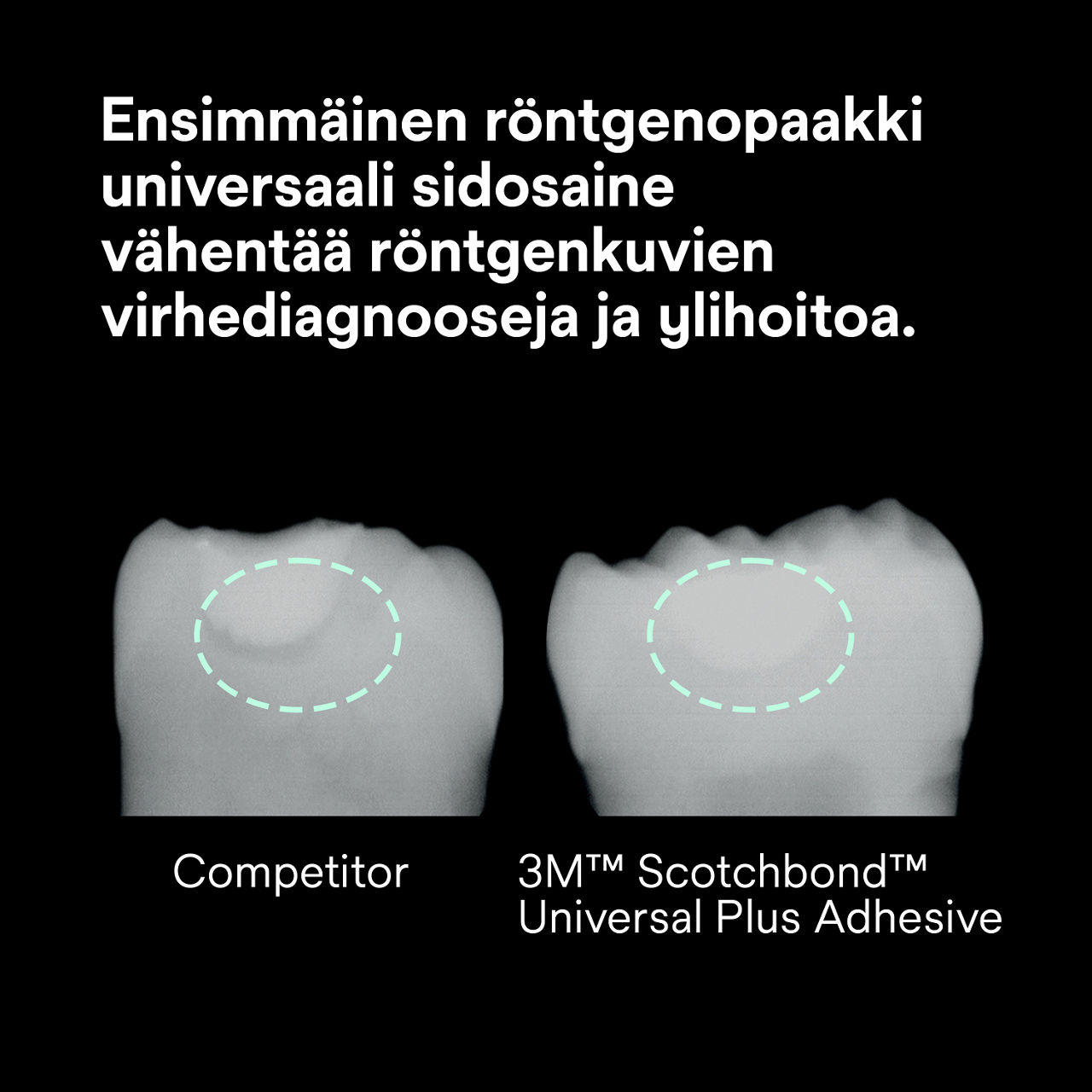 (2) Scotchbond Universal Plus Adhesive: Ensimmäinen röntgenopaakki universaali sidosaine vähentää röntgenriskiä