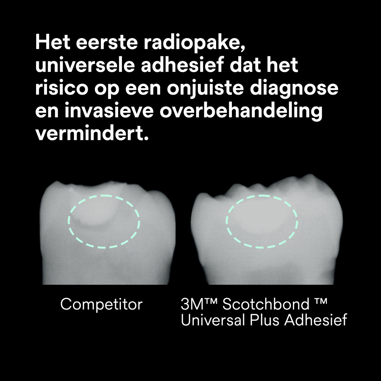 (2) Scotchbond Universal Plus Adhesief: Eerste radiopake universele adhesief vermindert risico op röntgenstraling.
