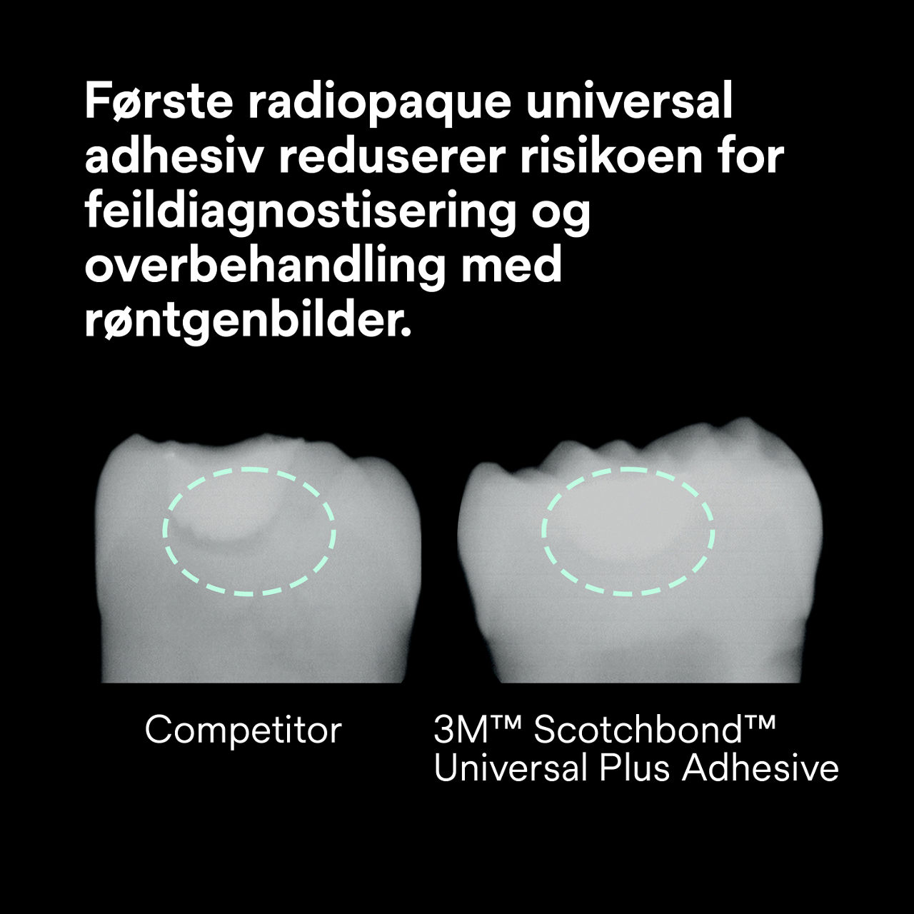 (2) ScotchBond™ Universal Adhesive Plus: Første røntgensynlige universelle adhesiv