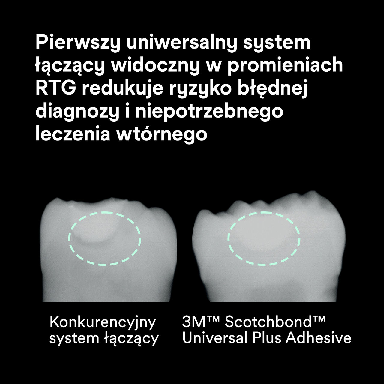 (2) Scotchbond™ Universal Adhesive Plus: Widoczny na zdjęciach rentgenowskich