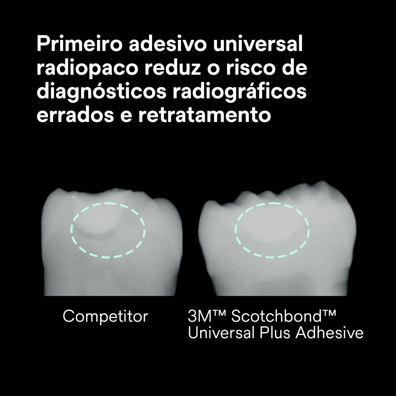 (2) Scotchbond Adesivo Universal Plus: Primeiro adesivo universal radiopaco, reduz o risco de raios-x